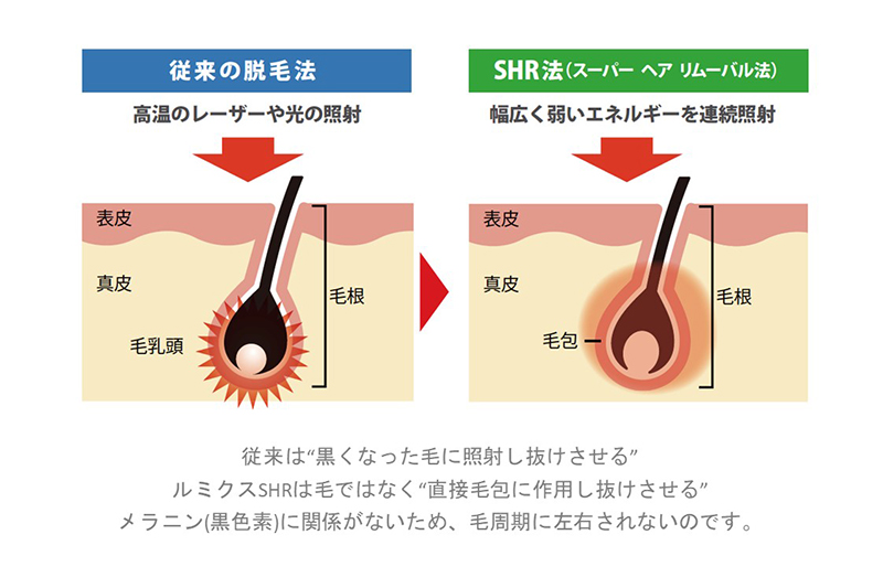 SHR脱毛について