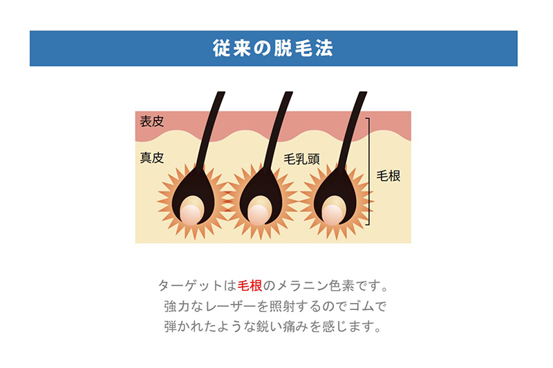 SHR脱毛について